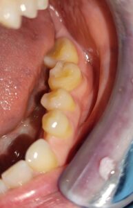Foto di controllo primo molare in sede a 6 mesi dal trapianto dentale autologo
