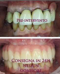 Implantologia Guidata a Modena
